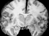 Diffuse cerebral edema in a patient with hypertensive encephalopathy